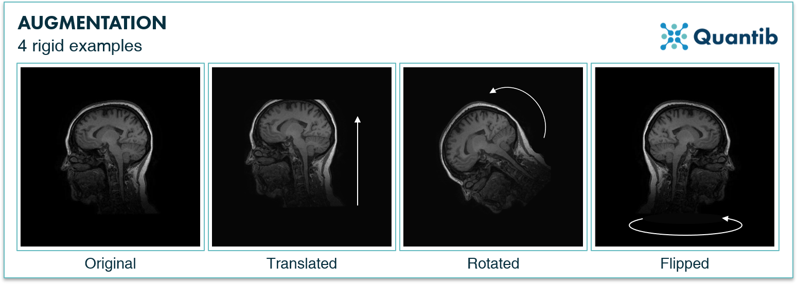 Image augmentation how to small radiology datasets